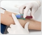 Aptamer and Timser partner to deliver world’s first blood test for cervical cancer