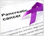 Microscopic changes in the liver can be used to predict pancreatic cancer spread