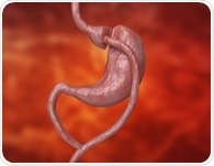 Study suggests gastric bypass can reduce cardiovascular disease risk, irrespective of weight loss