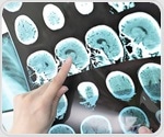 NIH grant supports advancement in cognitive screening after devastating type of stroke