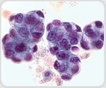 Brusatol may serve as potential adjuvant therapy for pancreatic ductal adenocarcinoma